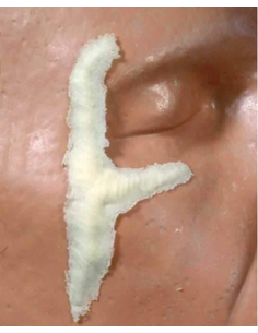 Prothèse FRW062 Y cicatrice BURMAN