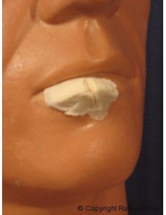 Prothèse FRW021 large lèvre fendue BURMAN