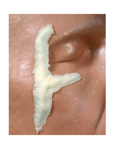 Prothèse FRW062 Y cicatrice BURMAN