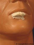 Prothèse FRW022 petite lèvre fendue BURMAN